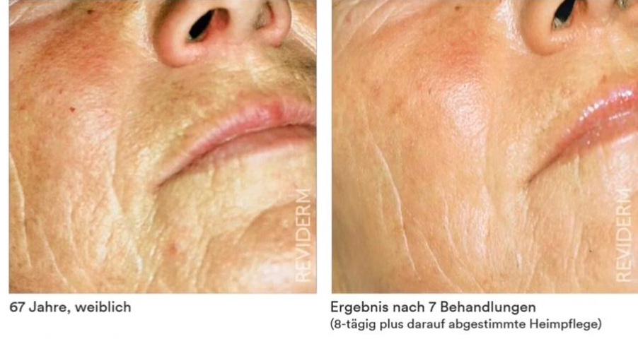 vorher nachher